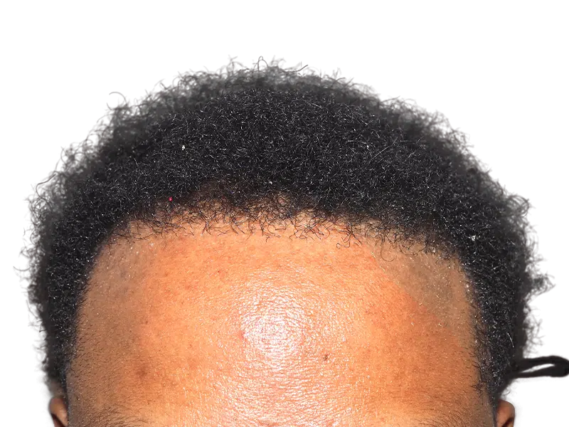 Hair transplant result: African American man's restored hairline. Natural, dense hair growth after procedure. Hair restoration success.