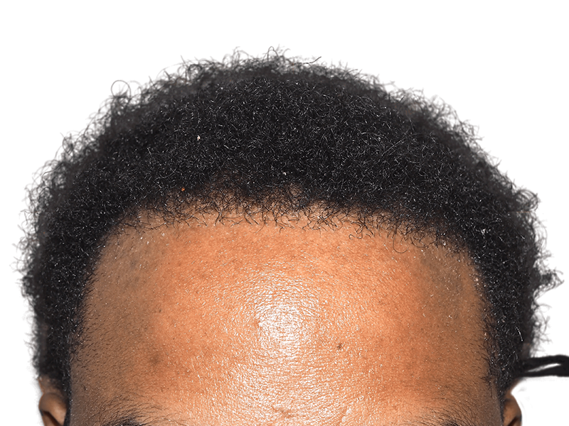 Hair restoration result: Natural, dense hairline on African American male. Hair transplant procedure example. Before/after unknown.