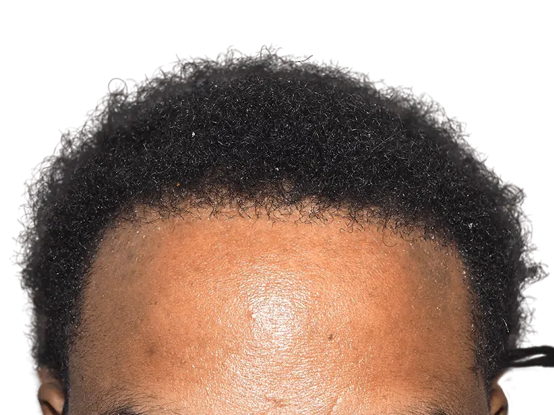 Hair restoration result: Natural, dense hairline on African American male. Hair transplant procedure example. Before/after unknown.