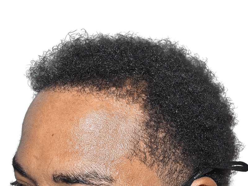 Hair transplant result: African American man's fuller, defined hairline. Hair restoration success. Before/after potential.