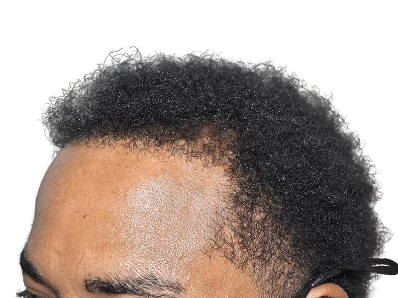 Hair transplant result: African American man's fuller, defined hairline. Hair restoration success. Before/after potential.