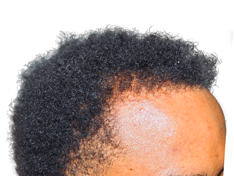 Receding hairline (African American man) before hair transplant. Showing grafts/plugs. Hair restoration results.