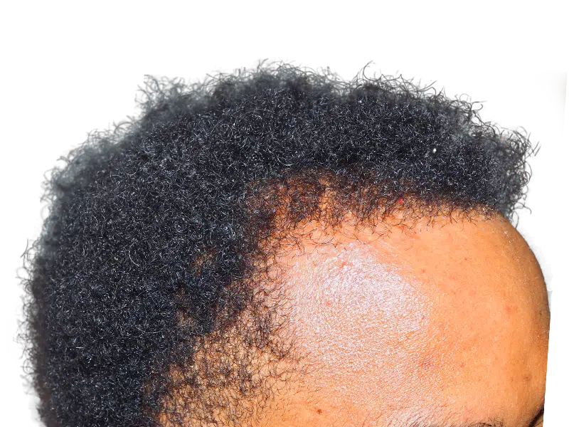Receding hairline (African American man) before hair transplant. Showing grafts/plugs. Hair restoration results.
