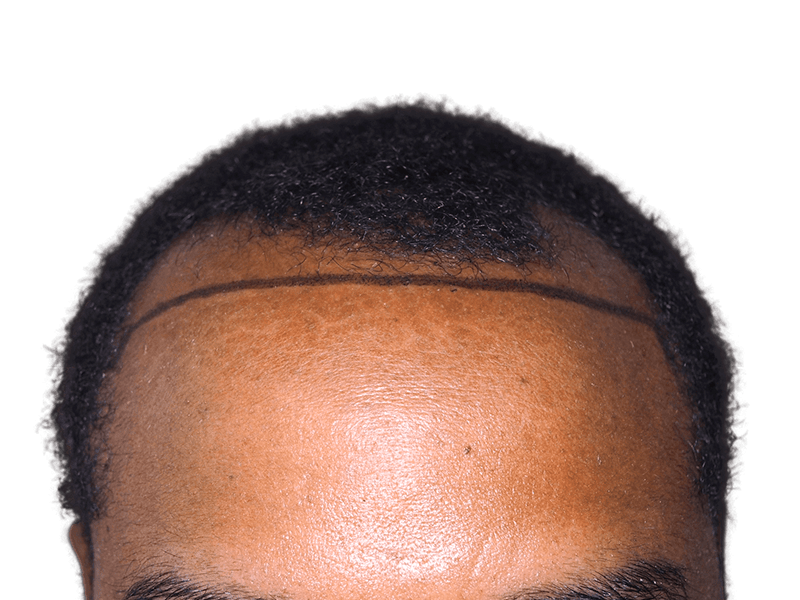 Before hair transplant: African American man's hairline marked for restoration. Shows potential hair loss solution.