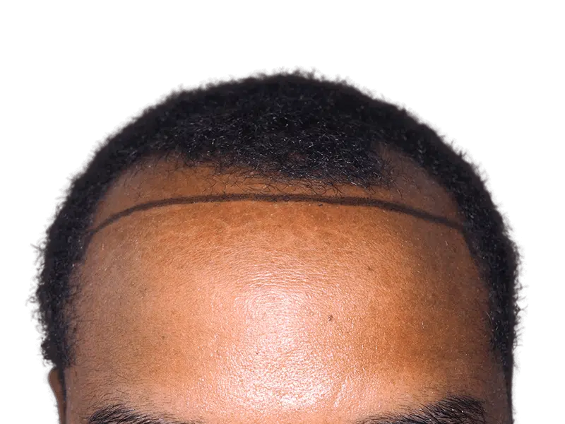 Before hair transplant: African American man's hairline marked for restoration. Shows potential hair loss solution.