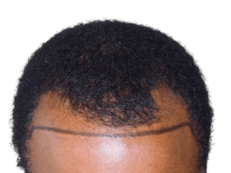 Hair transplant planning: African American man's hairline marked for restoration. Before hair transplant procedure.