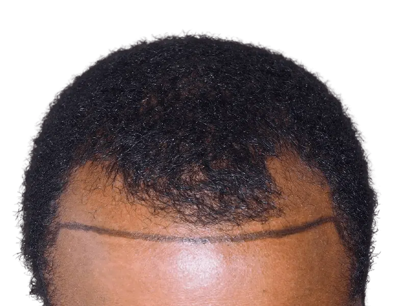Hair transplant planning: African American man's hairline marked for restoration. Before hair transplant procedure.