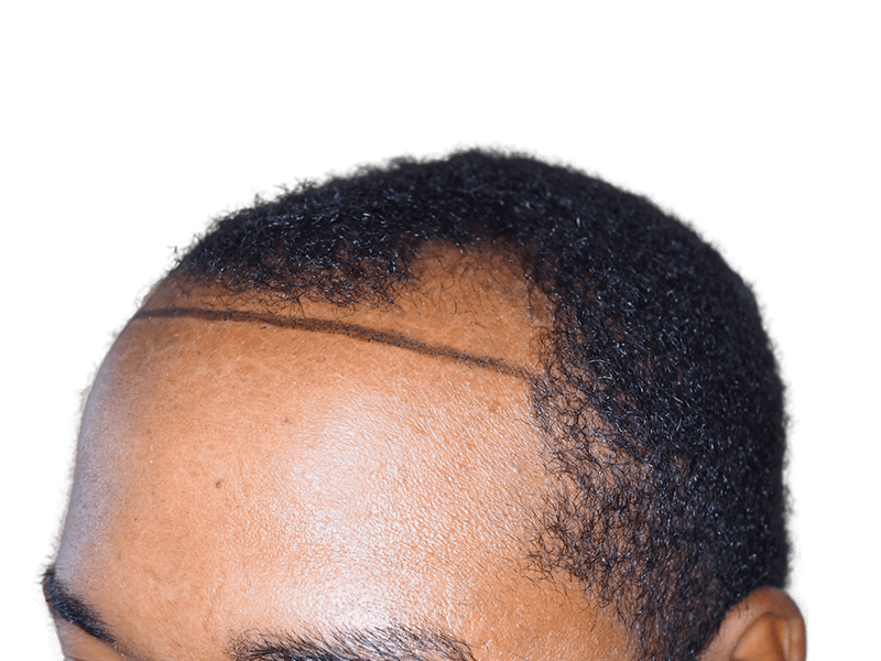 Hair transplant hairline marked on African American man. Shows potential hair restoration results. Before hair loss visible.