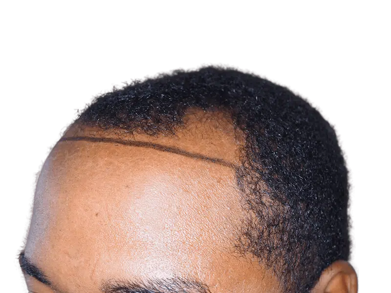 Hair transplant hairline marked on African American man. Shows potential hair restoration results. Before hair loss visible.
