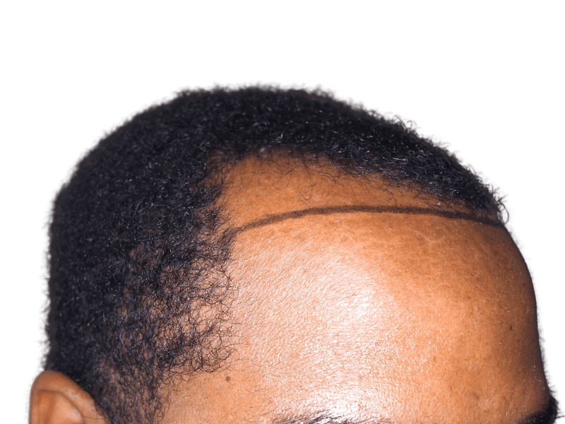 Hair transplant planning: African American man's hairline marked for restoration. Before procedure example.