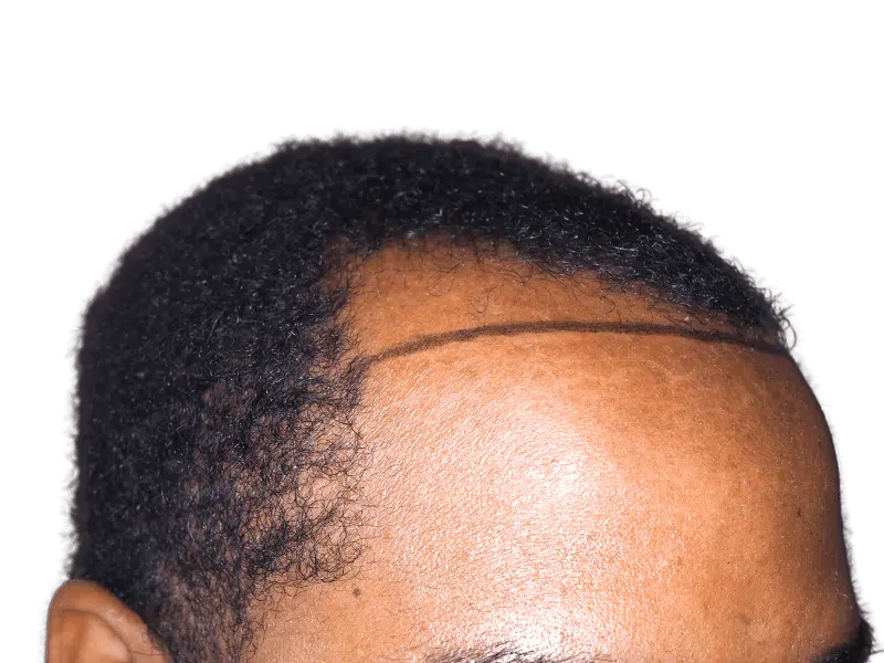 Hair transplant planning: African American man's hairline marked for restoration. Before procedure example.