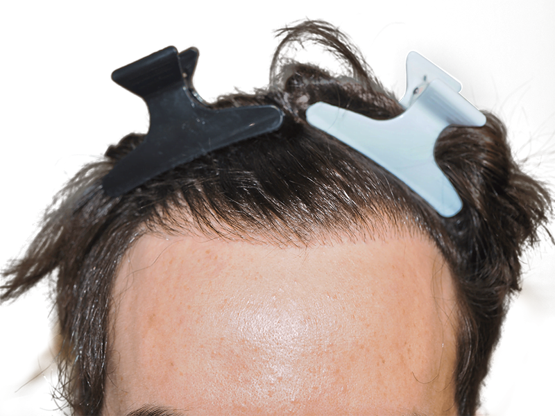 Hair transplant result: Close-up of hairline with new hair growth. Hair restoration progress. Before & after possible.