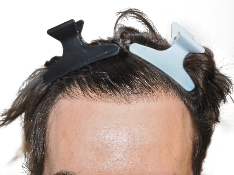 Hair transplant result: Close-up of hairline with new hair growth. Hair restoration progress. Before & after possible.