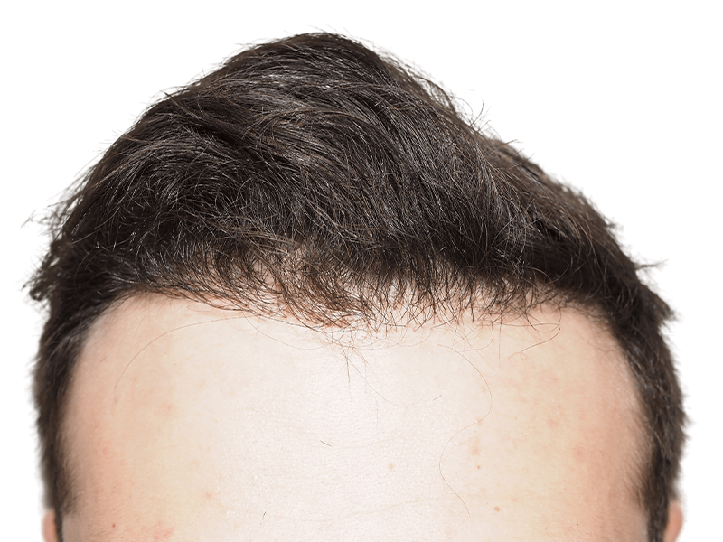 Before hair transplant: Receding hairline on fair-skinned man with dark brown hair. Hair restoration candidate.