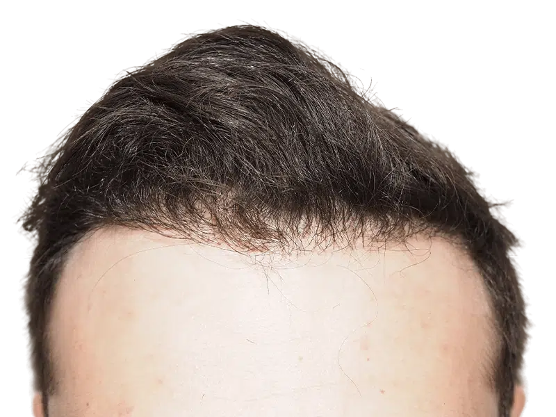 Before hair transplant: Receding hairline on fair-skinned man with dark brown hair. Hair restoration candidate.