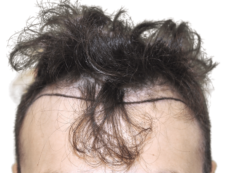 Hair transplant result: Defined hairline achieved. Before/after visible. Hair restoration success. Hispanic male.
