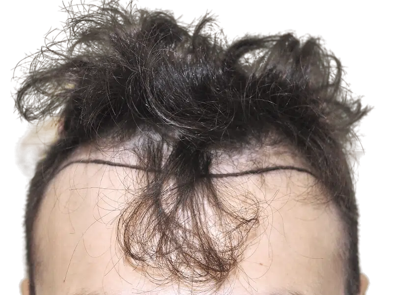 Hair transplant result: Defined hairline achieved. Before/after visible. Hair restoration success. Hispanic male.