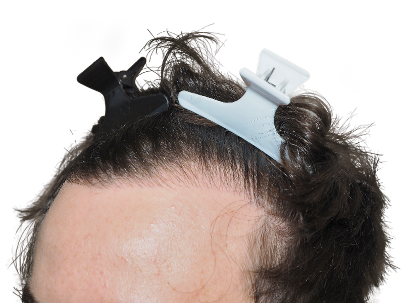 Hair transplant prep: Close-up of hairline with clips. Dark hair ready for restoration procedure. Before treatment.