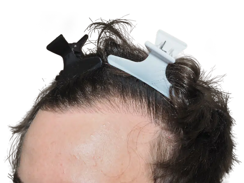 Hair transplant prep: Close-up of hairline with clips. Dark hair ready for restoration procedure. Before treatment.