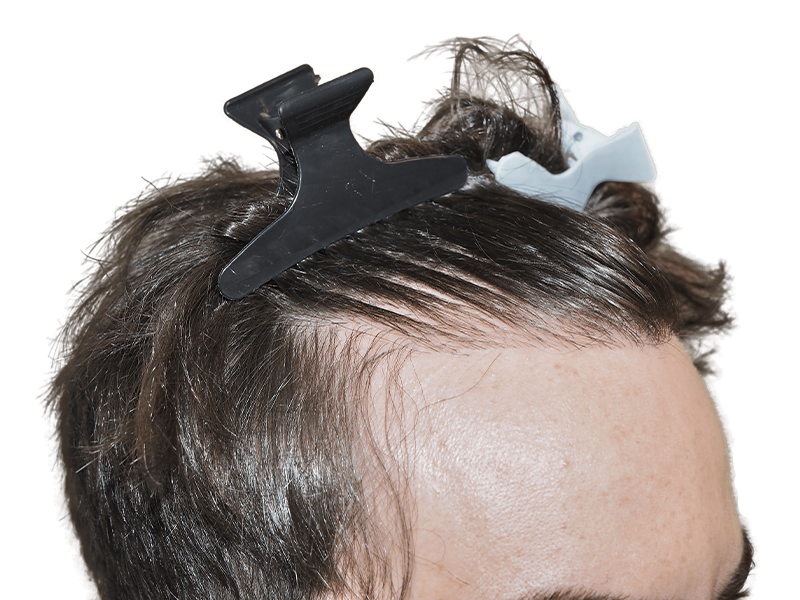 Close-up of hairline for hair restoration consultation. Assessing hair loss before potential transplant procedure.