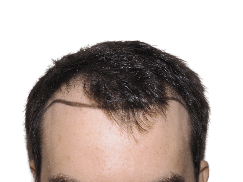 Before hair transplant: Thinning hairline marked for restoration. Hair loss treatment planning. Hair restoration procedure.