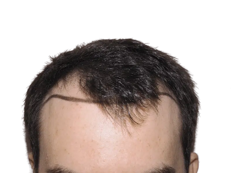Before hair transplant: Thinning hairline marked for restoration. Hair loss treatment planning. Hair restoration procedure.