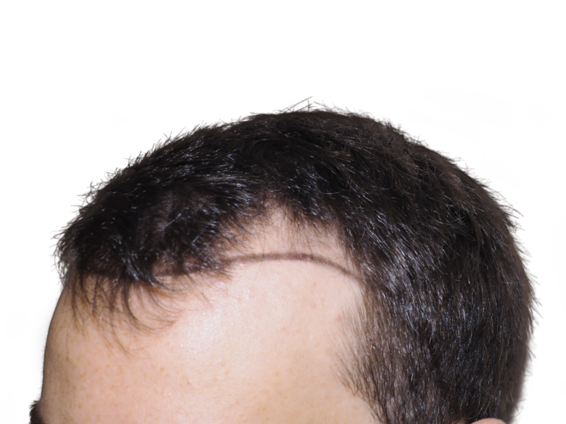 Hair transplant before: Thinning hairline marked for restoration. Shows potential hair transplant results.