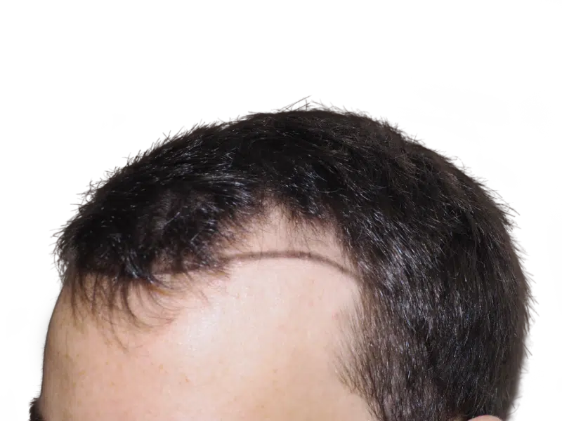 Hair transplant before: Thinning hairline marked for restoration. Shows potential hair transplant results.