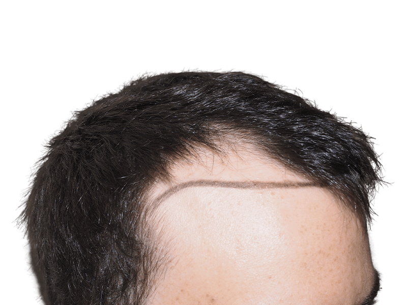 Hair transplant result: New hairline marked. Before/after density visible. Hair restoration success.