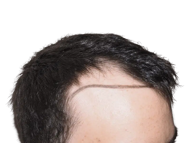 Hair transplant result: New hairline marked. Before/after density visible. Hair restoration success.