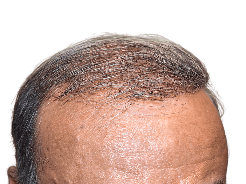 Thinning, graying hairline. Potential hair restoration candidate. Before hair transplant results. Receding hairline visible.