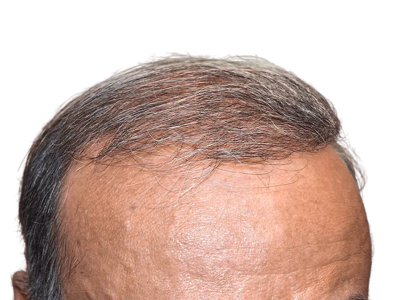 Thinning, graying hairline. Potential hair restoration candidate. Before hair transplant results. Receding hairline visible.