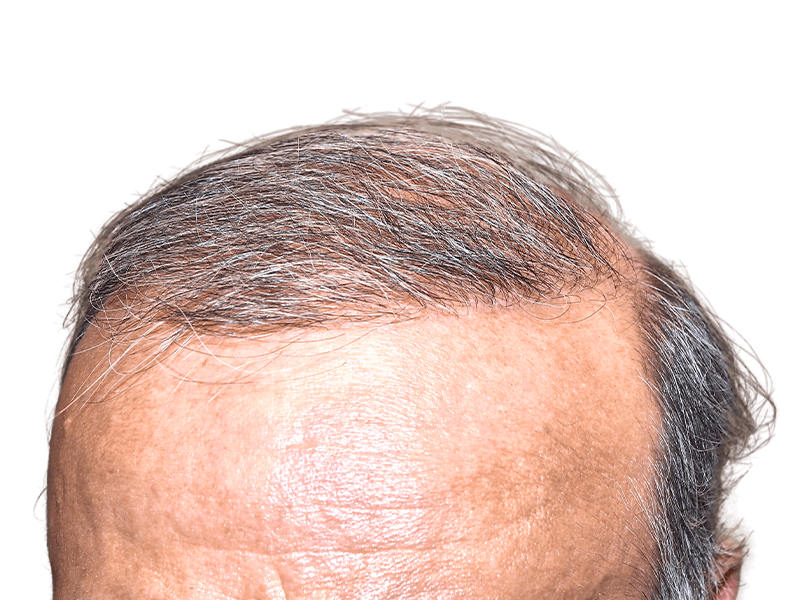 Hair transplant result: Man's forehead showing restored hairline. Graying hair, improved density. Hair restoration success.