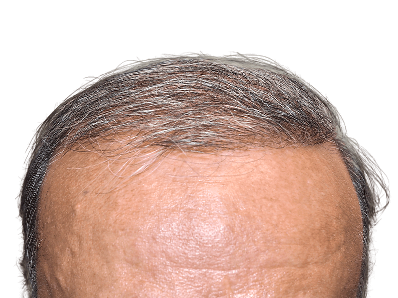 Receding hairline. Potential hair transplant candidate. Consult for hair restoration options & before/after results.