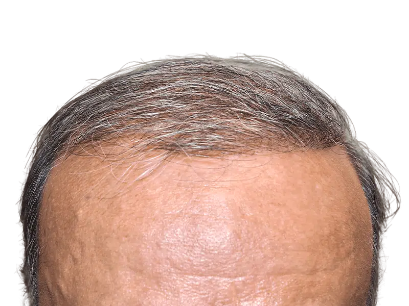 Receding hairline. Potential hair transplant candidate. Consult for hair restoration options & before/after results.