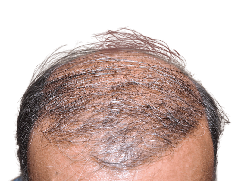 Receding hairline. Gray & dark hair. Possible hair loss. Consider hair restoration or transplant options. Before/After results unclear.