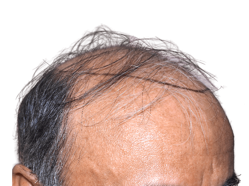 Thinning Asian hairline. Potential hair restoration candidate. Consult for hair transplant options & before/after results.