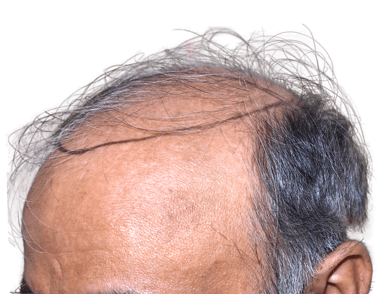 Receding hairline (Asian male). Before hair transplant. Graying, sparse frontal hair. Hair restoration candidate.