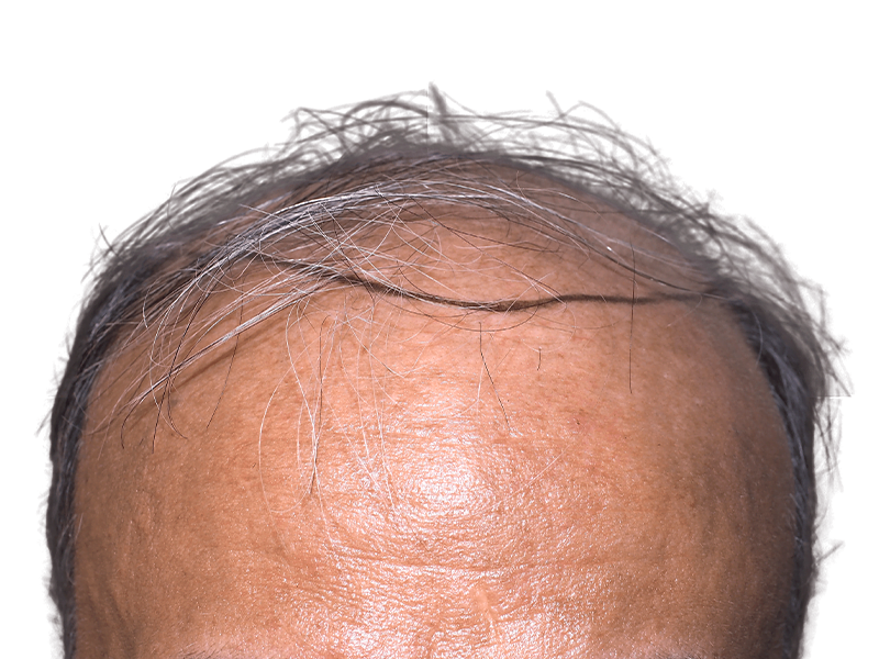 Thinning hairline. Hair loss signs. Potential hair transplant candidate. Before treatment example.