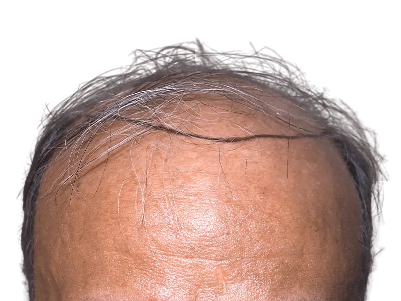Thinning hairline. Hair loss signs. Potential hair transplant candidate. Before treatment example.