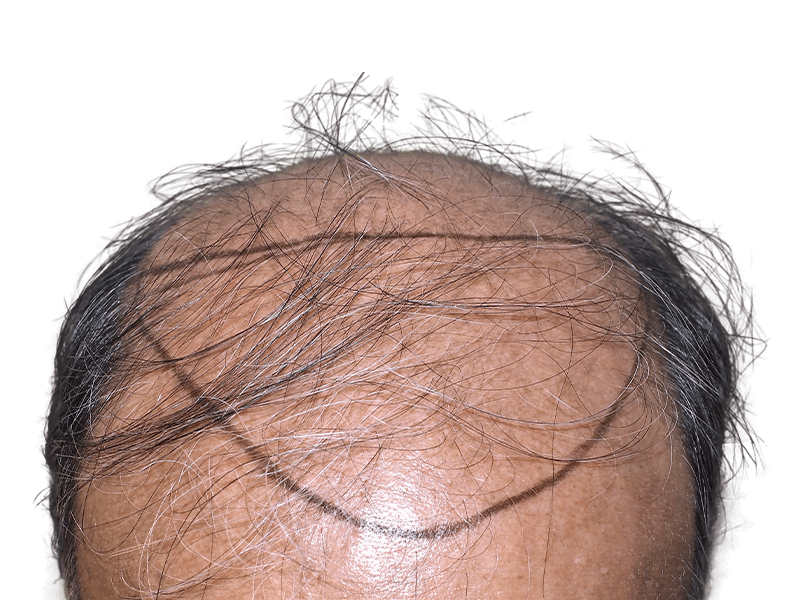Thinning hair before hair transplant. Marked hairline shows proposed restoration. Asian male with graying hair.