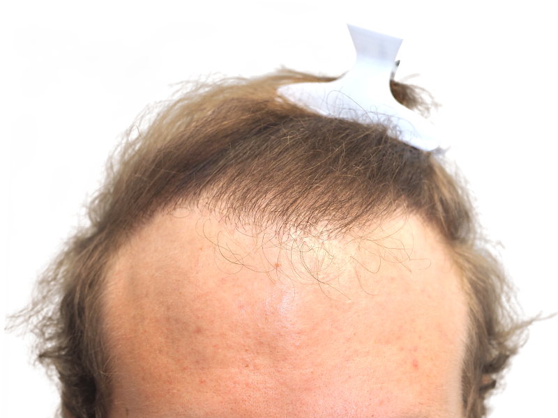Before hair transplant: Receding hairline on fair-skinned man. Hair restoration candidate. Sparse hair visible. White device on head.