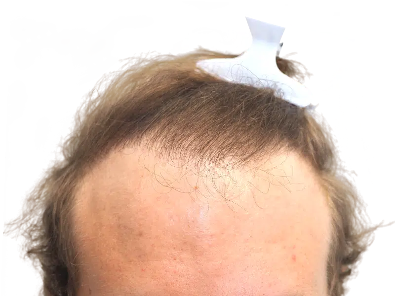 Before hair transplant: Receding hairline on fair-skinned man. Hair restoration candidate. Sparse hair visible. White device on head.