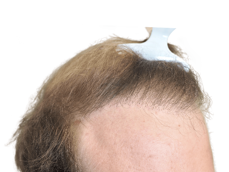 Receding hairline close-up. Potential hair loss or hair transplant candidate. Before/after hair restoration example.