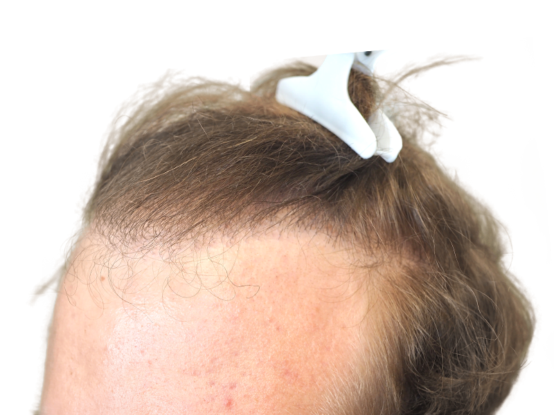 Hair transplant result: Improved hairline and density. Before & after showing new hair growth. Hair restoration success.