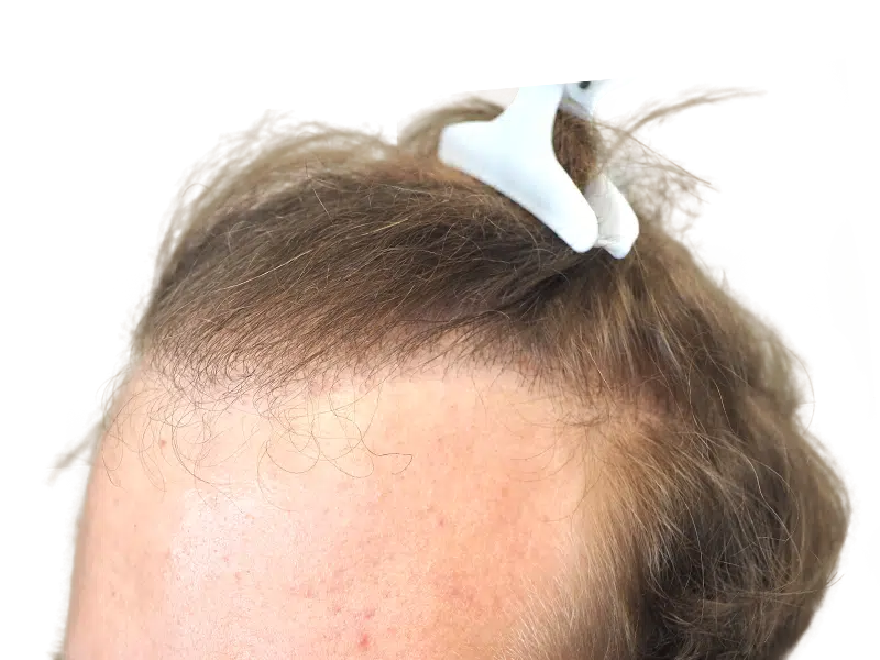 Hair transplant result: Improved hairline and density. Before & after showing new hair growth. Hair restoration success.