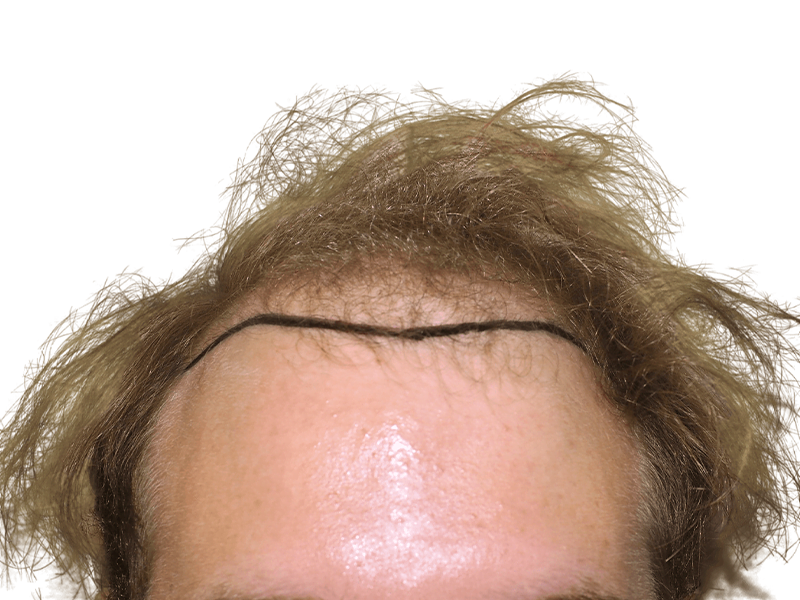 Hair transplant planning: Before hairline marked on forehead. Shows potential hair restoration results.