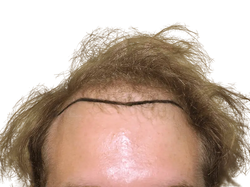 Hair transplant planning: Before hairline marked on forehead. Shows potential hair restoration results.