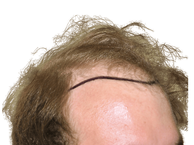 Hair transplant scar on forehead. Before/after hair restoration result. Thinning hairline, light brown hair. Hair loss treatment.