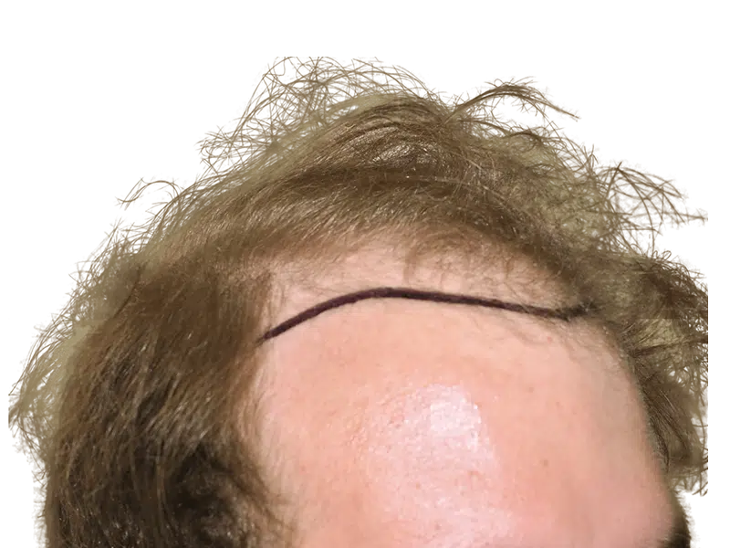 Hair transplant scar on forehead. Before/after hair restoration result. Thinning hairline, light brown hair. Hair loss treatment.